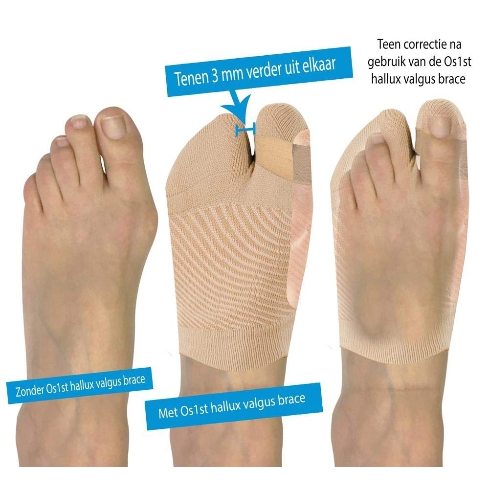 OS1st Unisex HV3 Bunion Brace (One Sleeve) Natural - OS1-1334N NATURAL - NATURAL, Small/Medium